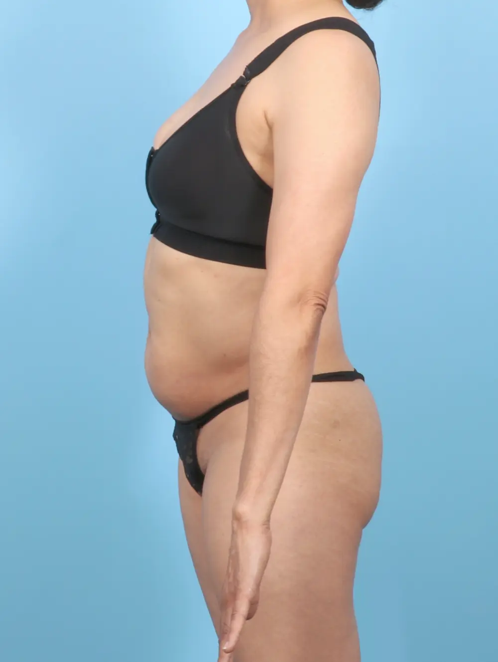 Tummy Tuck Patient Photo - Case 57013 - before view-2