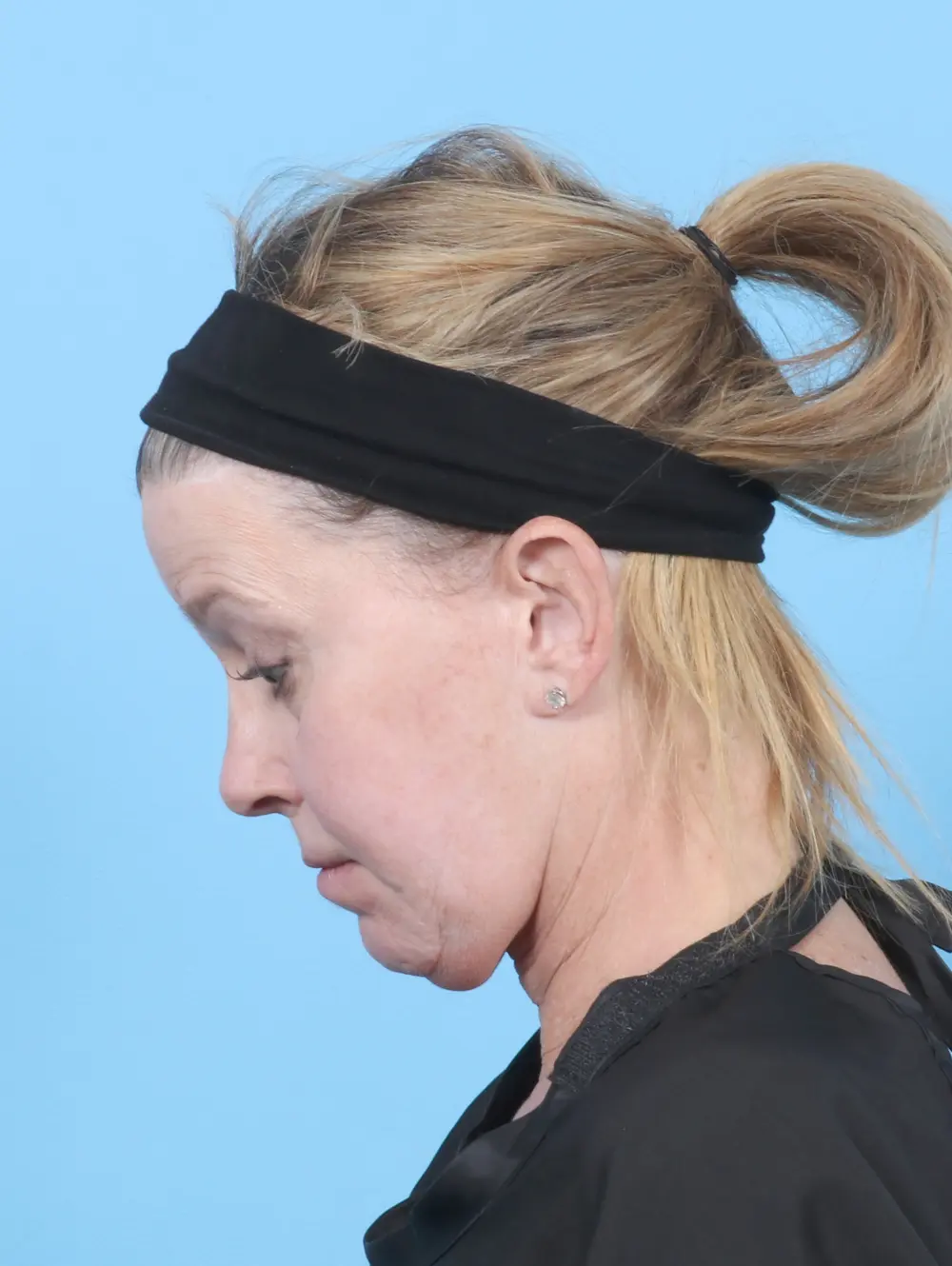 Facelift / Neck Lift Patient Photo - Case 57079 - before view-3