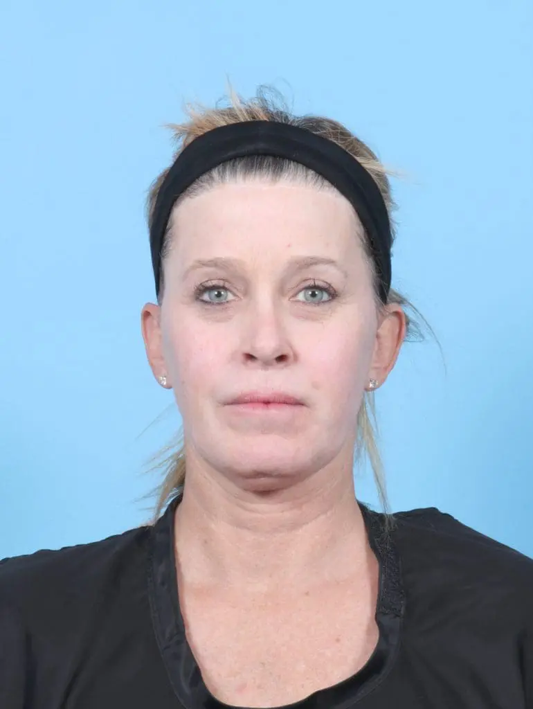 Facelift / Neck Lift - Case 57079 - Before