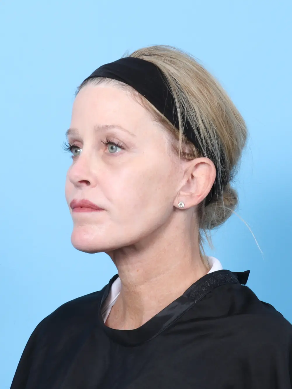 Facelift / Neck Lift Patient Photo - Case 57079 - after view-1
