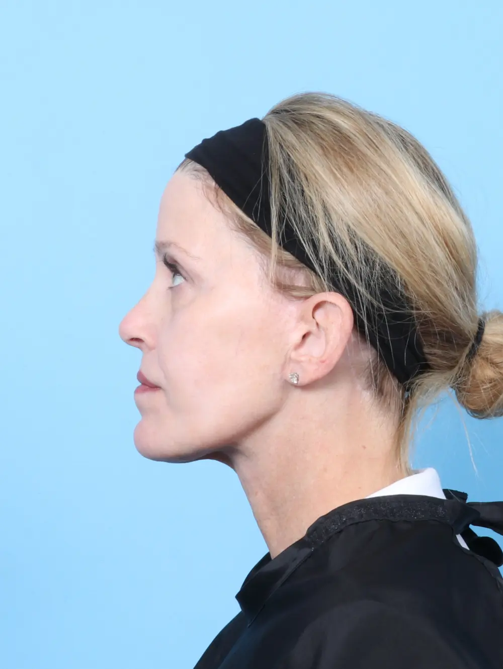 Facelift / Neck Lift Patient Photo - Case 57079 - after view-2