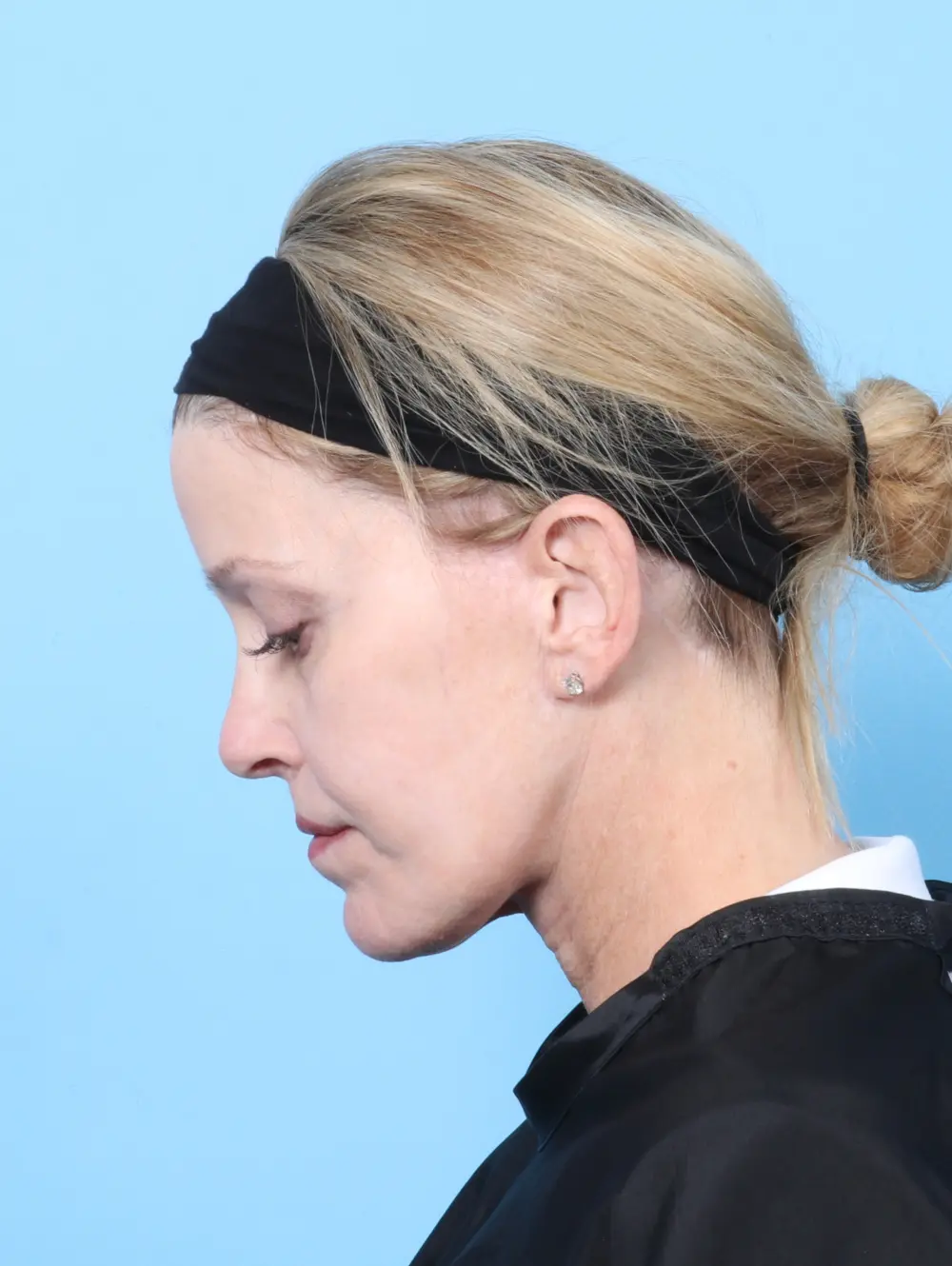 Facelift / Neck Lift Patient Photo - Case 57079 - after view-3