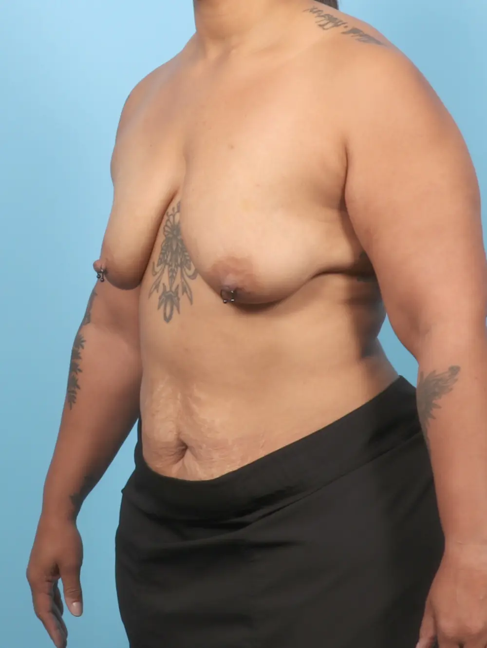 Breast Lift/Reduction with Implants Patient Photo - Case 57113 - before view-1