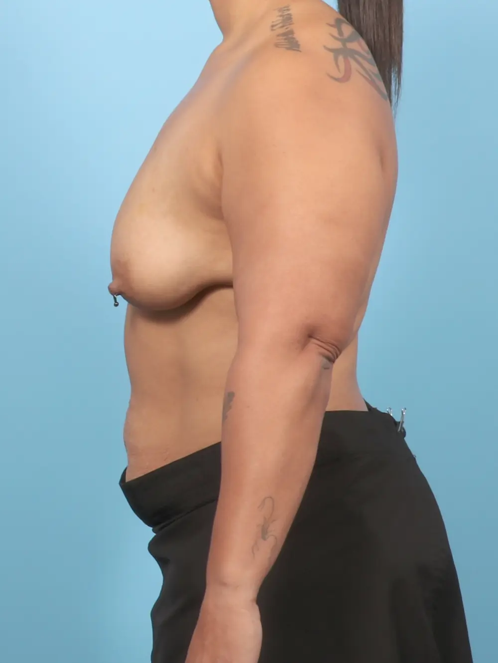 Breast Lift/Reduction with Implants Patient Photo - Case 57113 - before view-2