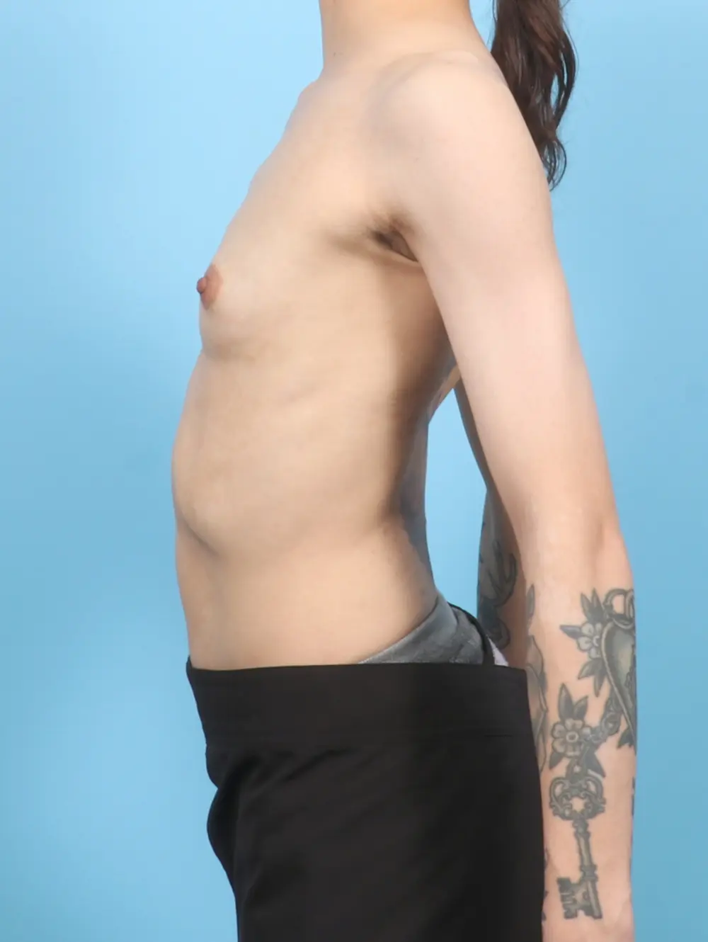Breast Augmentation Patient Photo - Case 57121 - before view-2