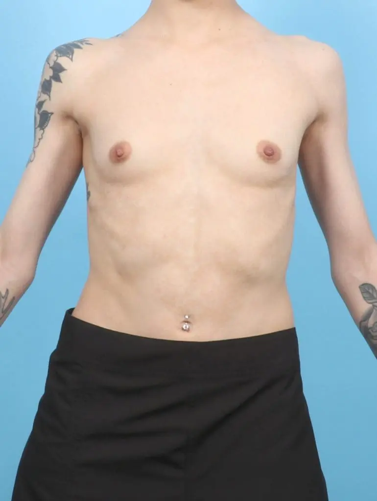 Breast Augmentation - Case 57121 - Before