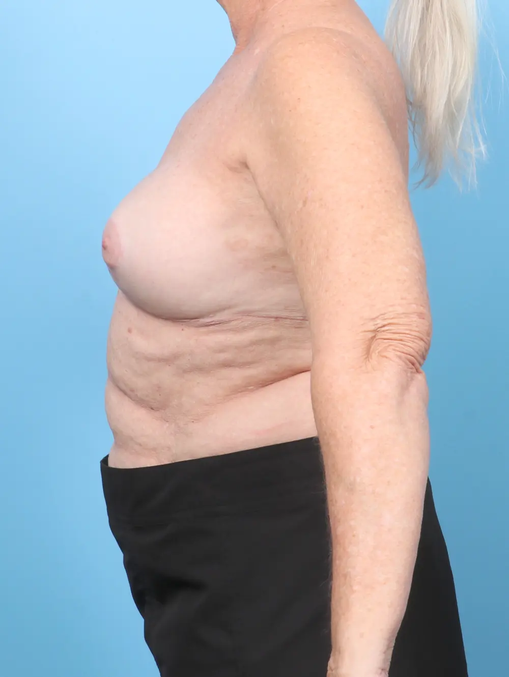 Breast Implant Revision Patient Photo - Case 57129 - after view-2