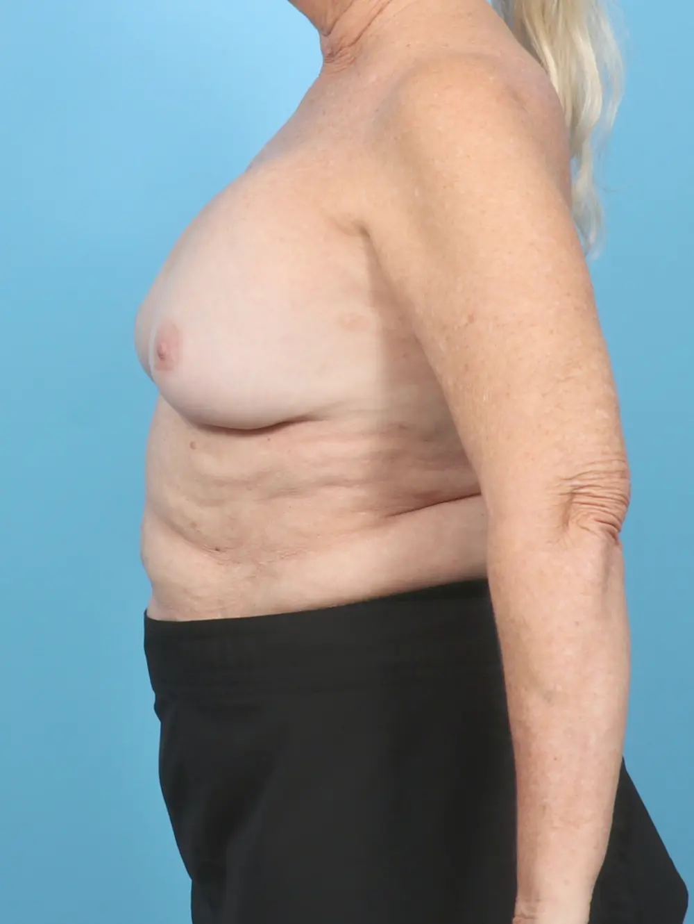 Breast Implant Revision Patient Photo - Case 57129 - before view-2