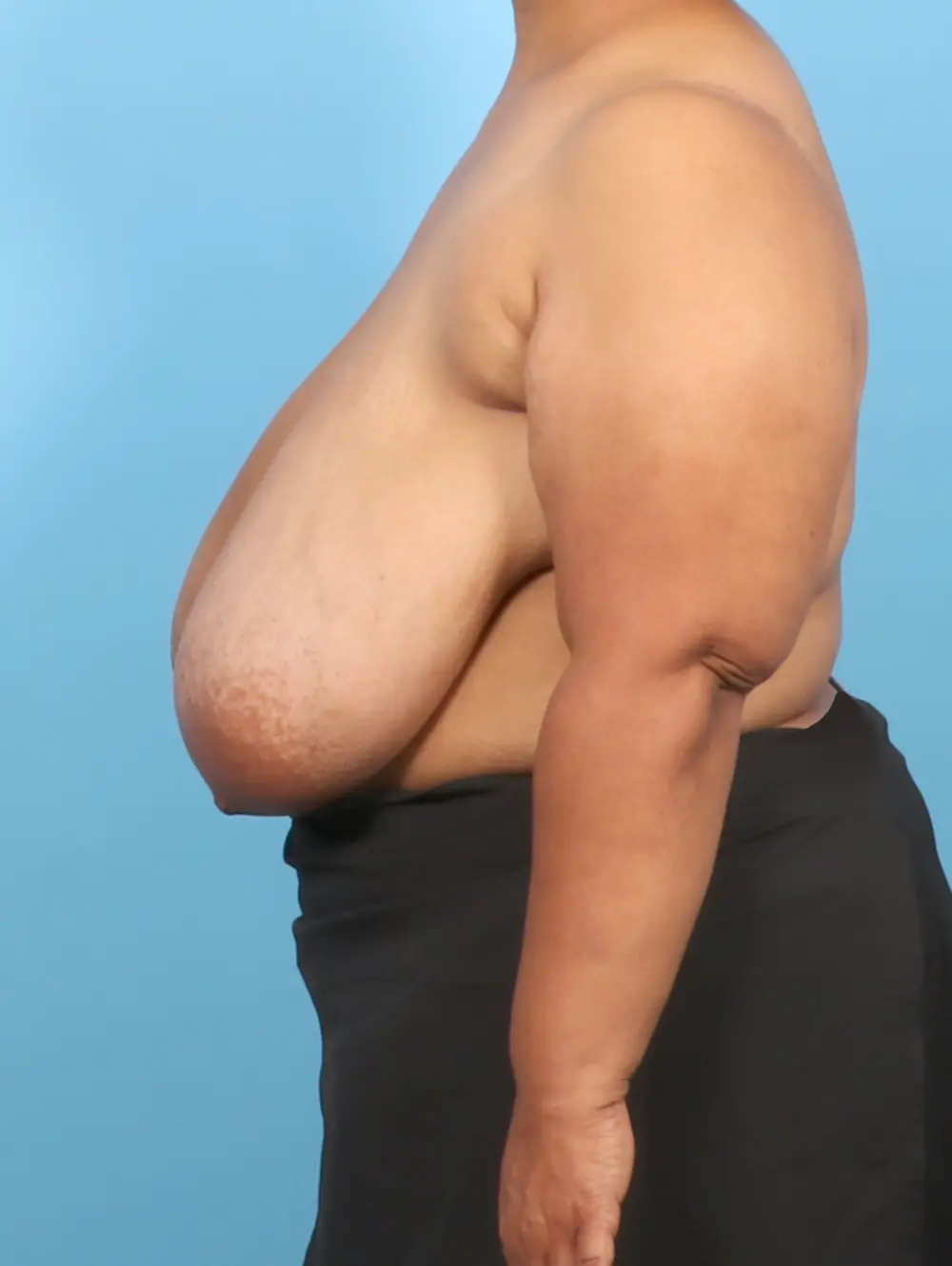 Breast Lift/Reduction w/o Implants Patient Photo - Case 57181 - before view-2