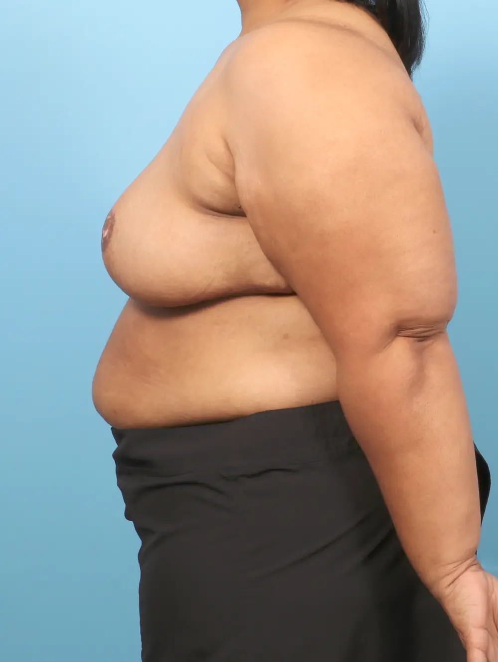 Breast Lift/Reduction w/o Implants Patient Photo - Case 57181 - after view-2