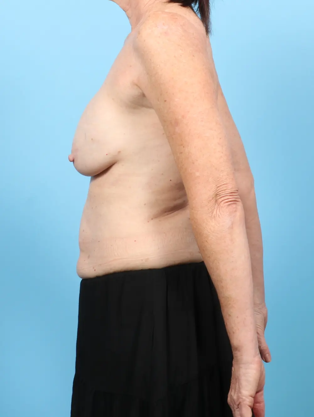 Breast Implant Removal Patient Photo - Case 57189 - before view-2