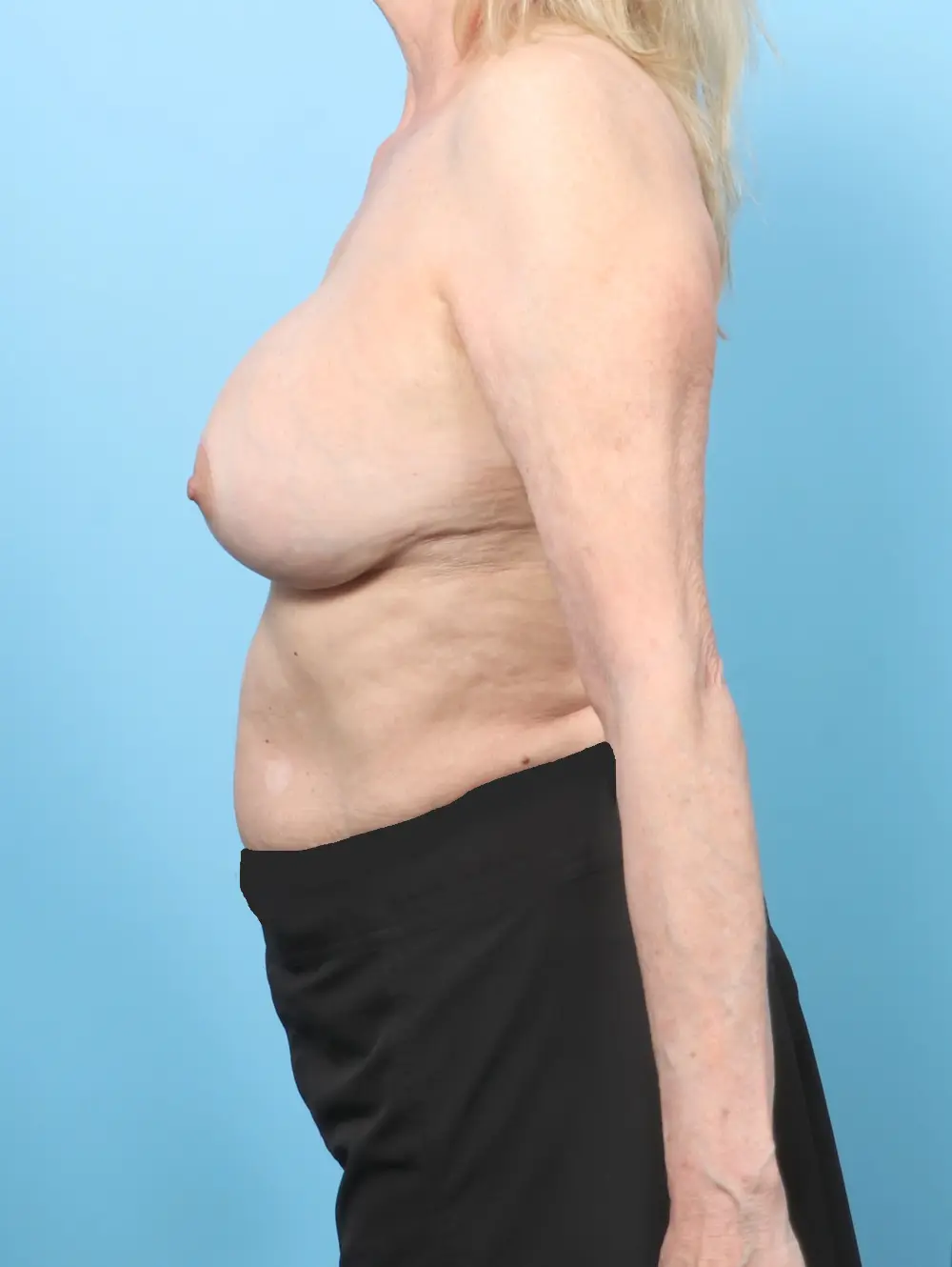 Breast Implant Revision Patient Photo - Case 57229 - after view-2