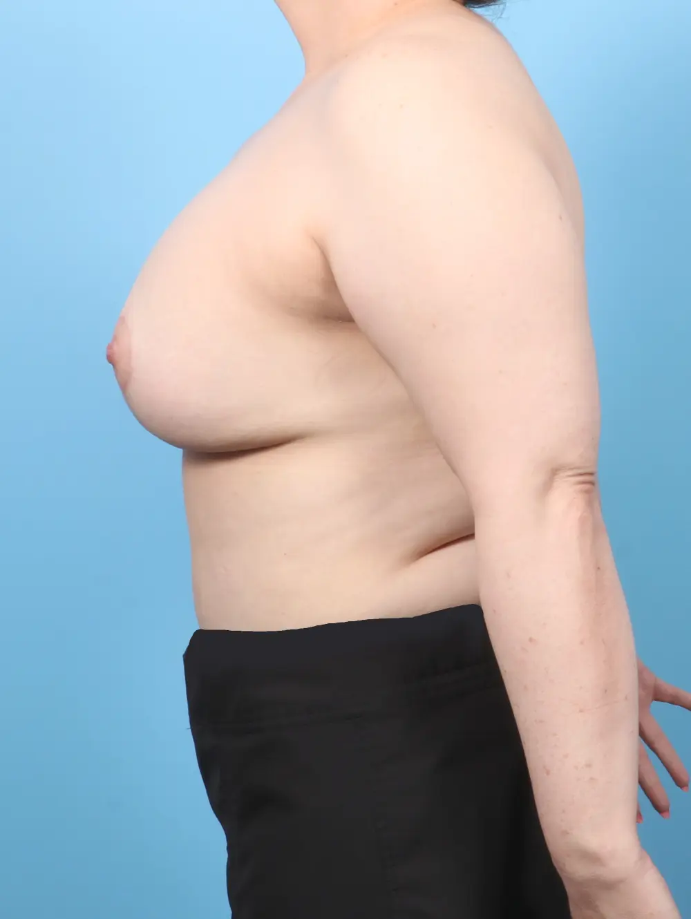 Breast Lift/Reduction with Implants Patient Photo - Case 57262 - after view-2