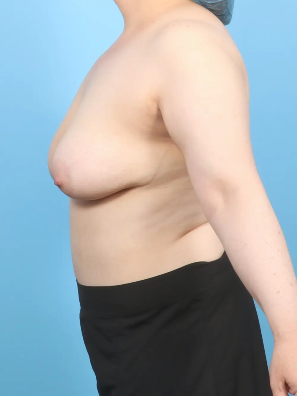 Breast Lift/Reduction with Implants Patient Photo - Case 57262 - before view-2