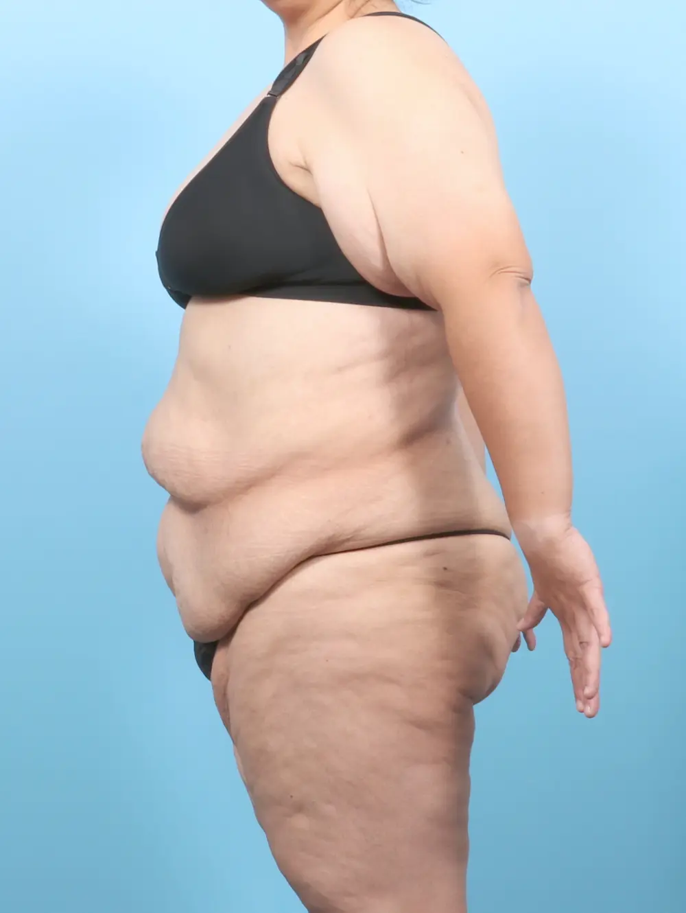 After Weight Loss Patient Photo - Case 57270 - before view-2