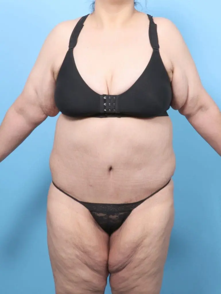 After Weight Loss - Case 57270 - After