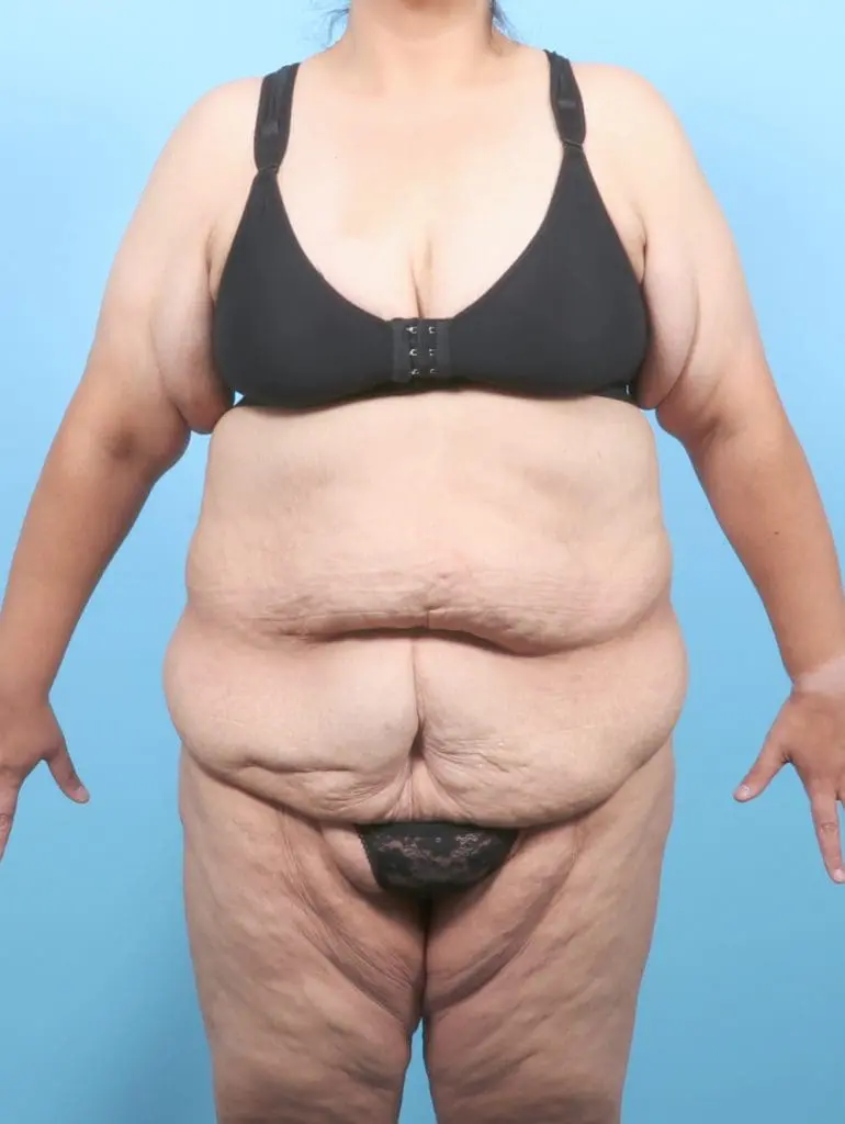 After Weight Loss - Case 57270 - Before