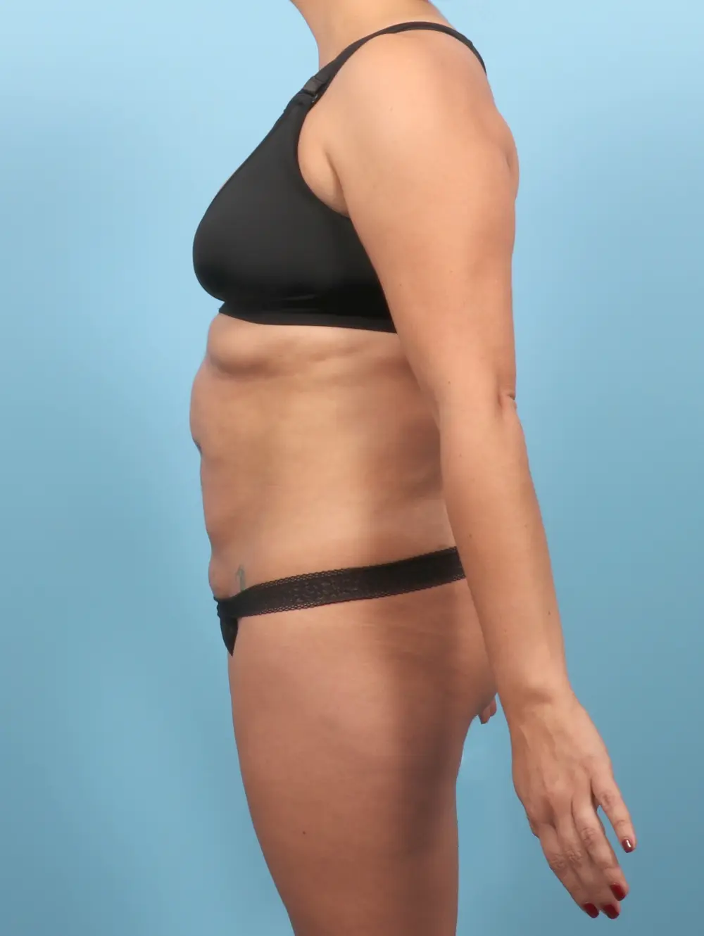 Tummy Tuck Patient Photo - Case 57278 - before view-2