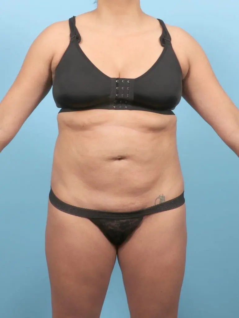 Tummy Tuck - Case 57278 - Before