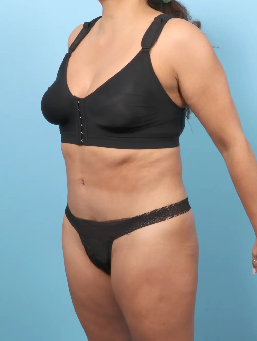 Tummy Tuck Patient Photo - Case 57278 - after view-1