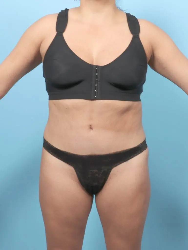 Tummy Tuck - Case 57278 - After