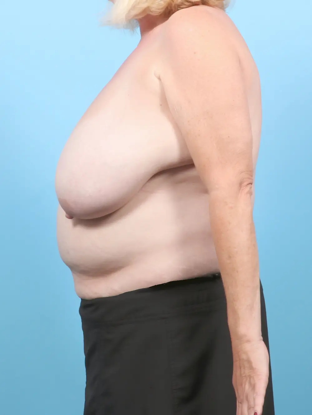 Breast Lift/Reduction w/o Implants Patient Photo - Case 57314 - before view-2
