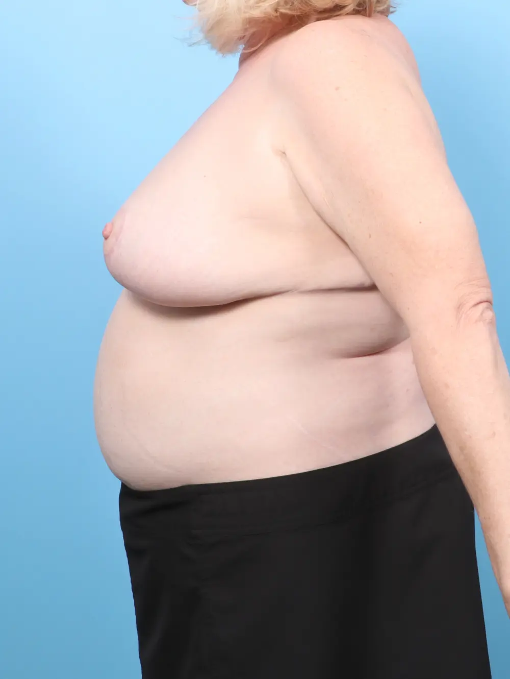 Breast Lift/Reduction w/o Implants Patient Photo - Case 57314 - after view-2