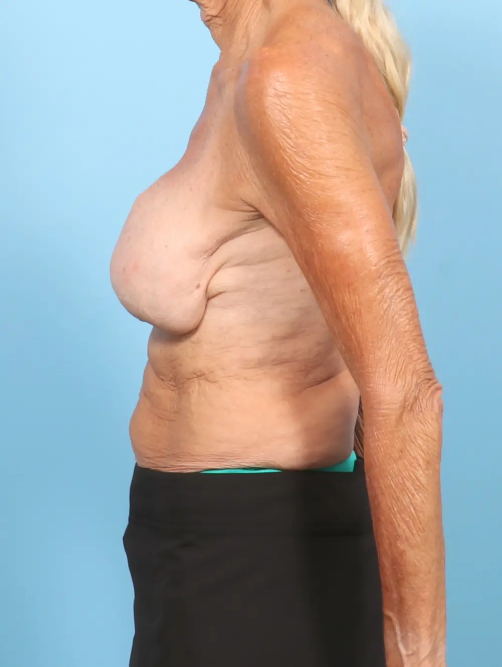 Breast Implant Revision Patient Photo - Case 57330 - before view-2
