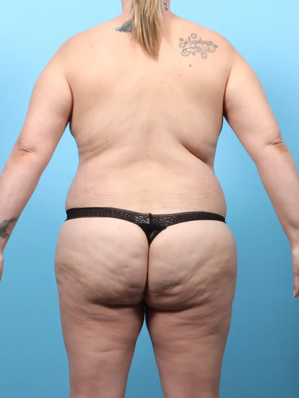 Body Lift Patient Photo - Case 57339 - after view-3