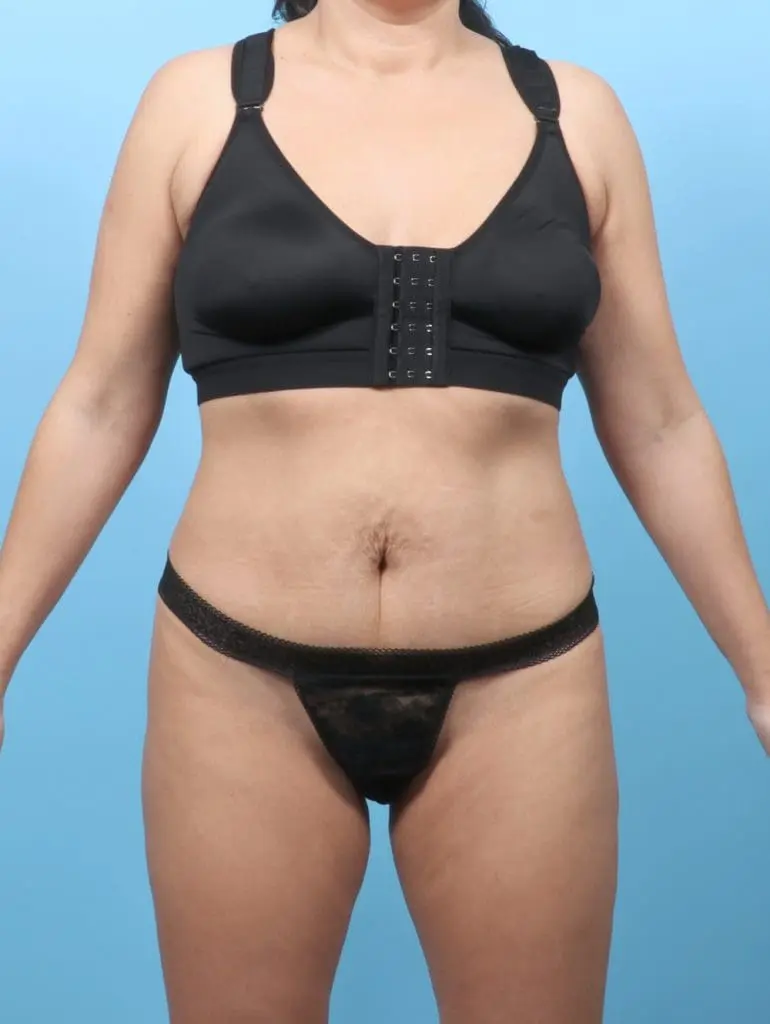 Ledgectomy - Case 57358 - After