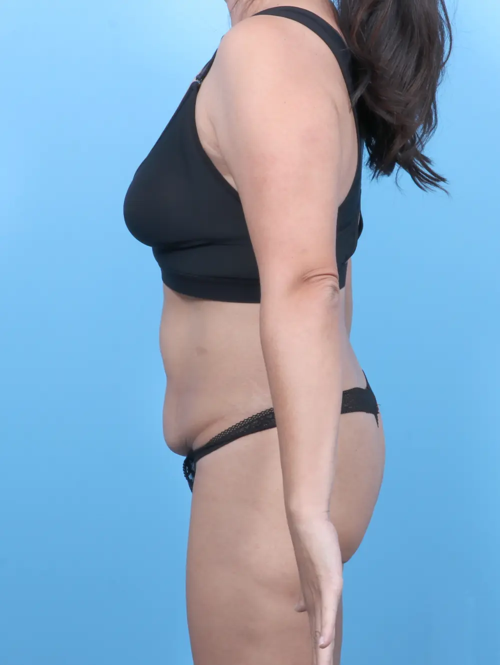 Ledgectomy Patient Photo - Case 57358 - before view-2