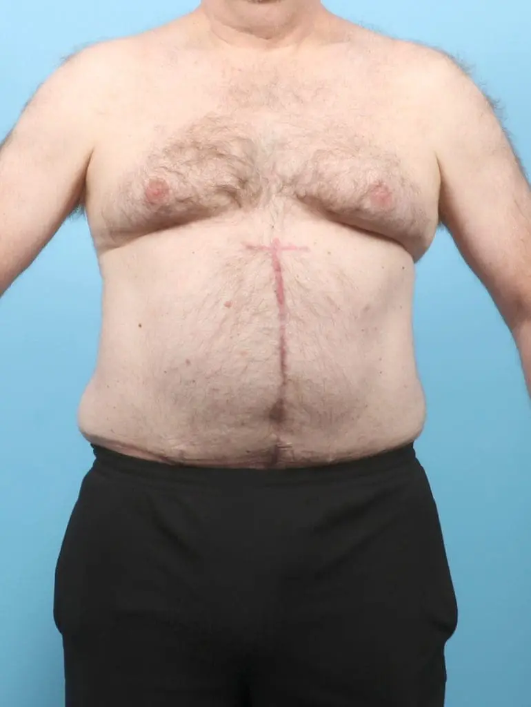 After Weight Loss - Case 57382 - After