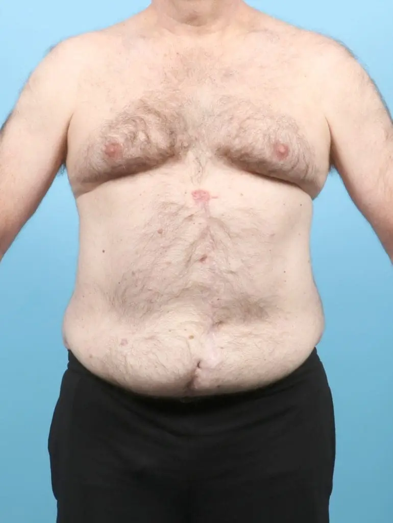 After Weight Loss - Case 57382 - Before