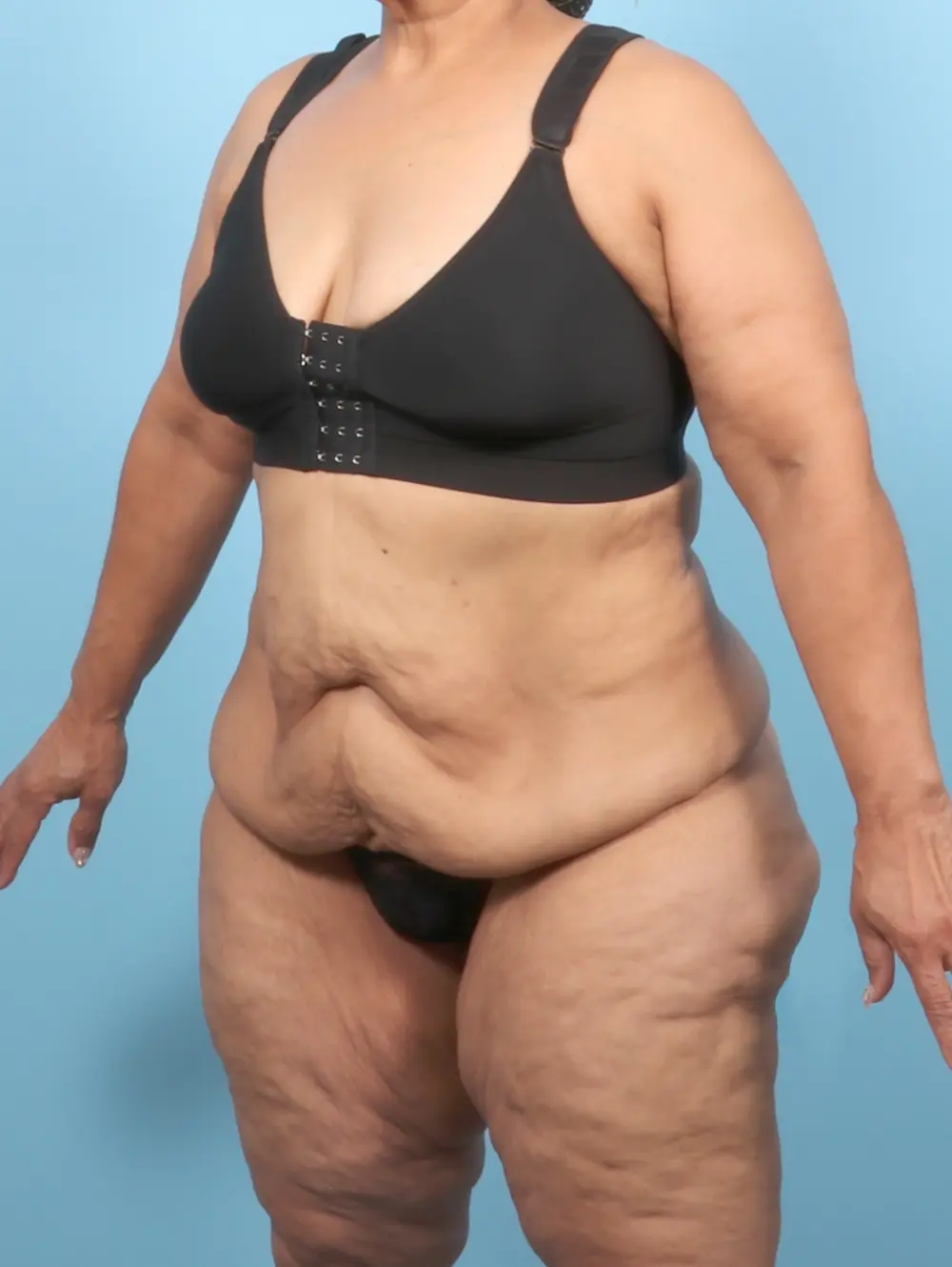 After Weight Loss Patient Photo - Case 57390 - before view-1