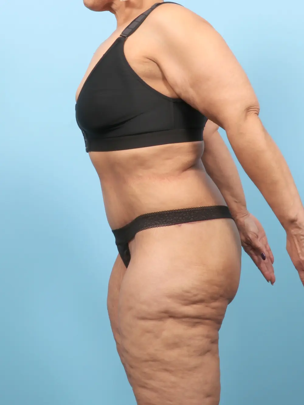 After Weight Loss Patient Photo - Case 57390 - after view-2