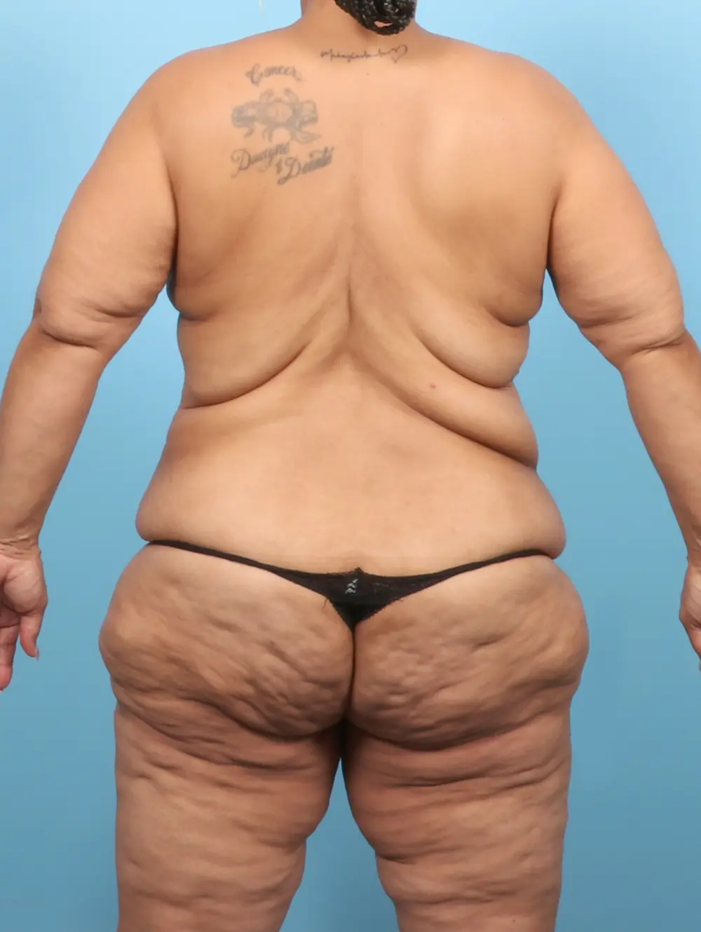After Weight Loss Patient Photo - Case 57390 - before view-3
