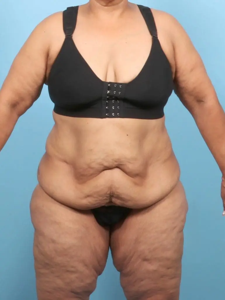After Weight Loss - Case 57390 - Before