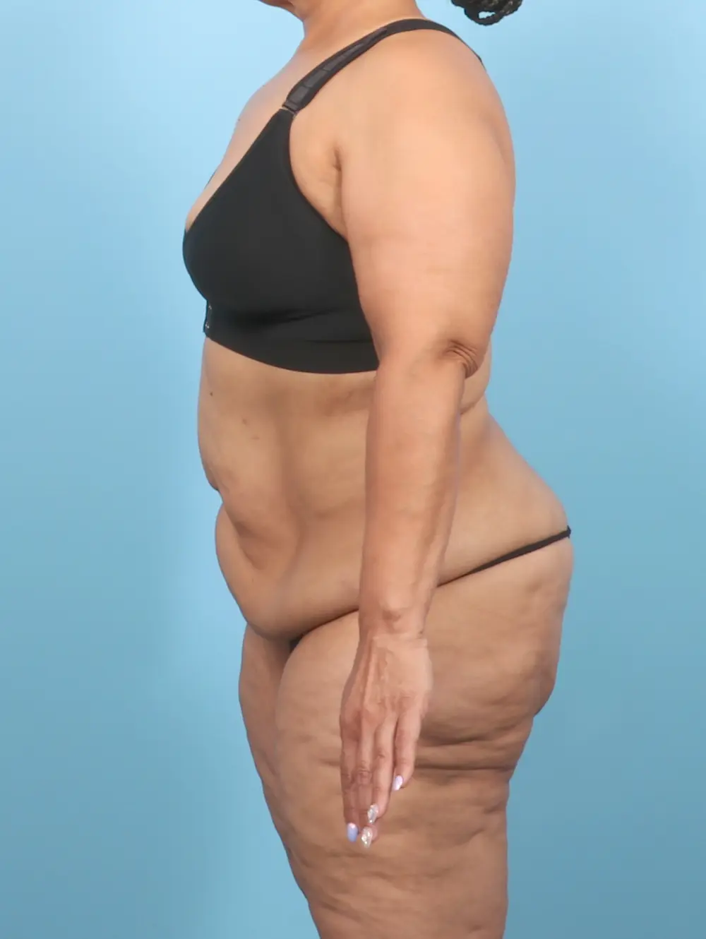 After Weight Loss Patient Photo - Case 57390 - before view-2