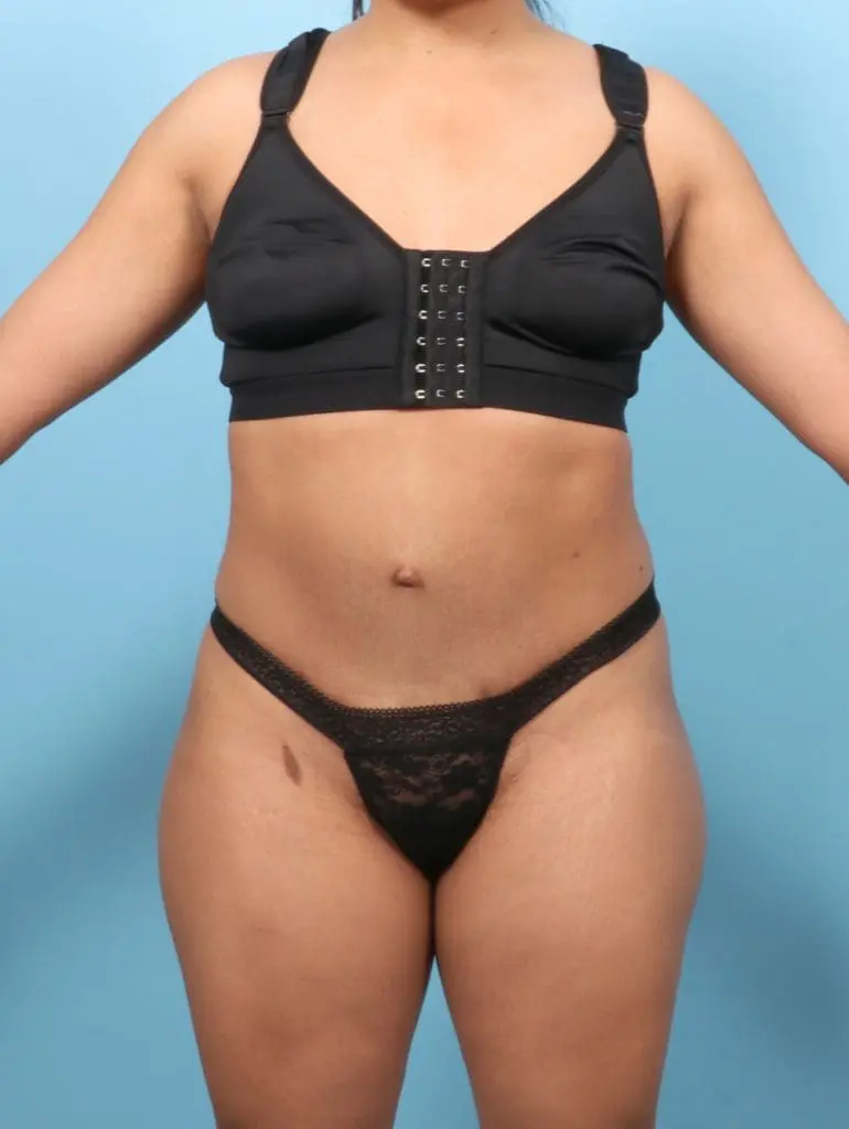 Tummy Tuck - Case 57464 - After