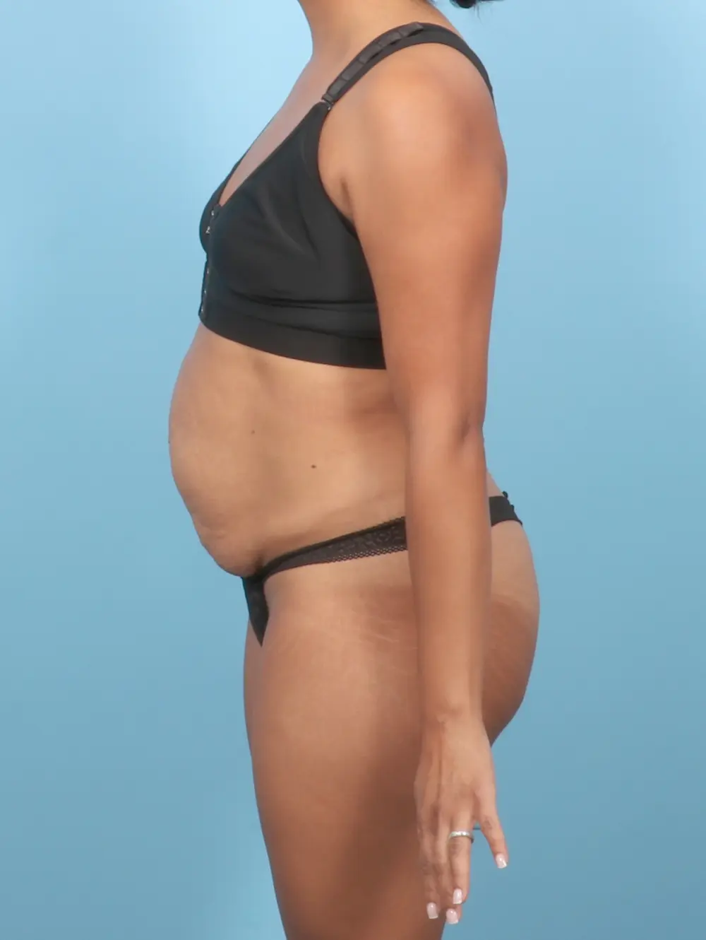 Tummy Tuck Patient Photo - Case 57464 - before view-2