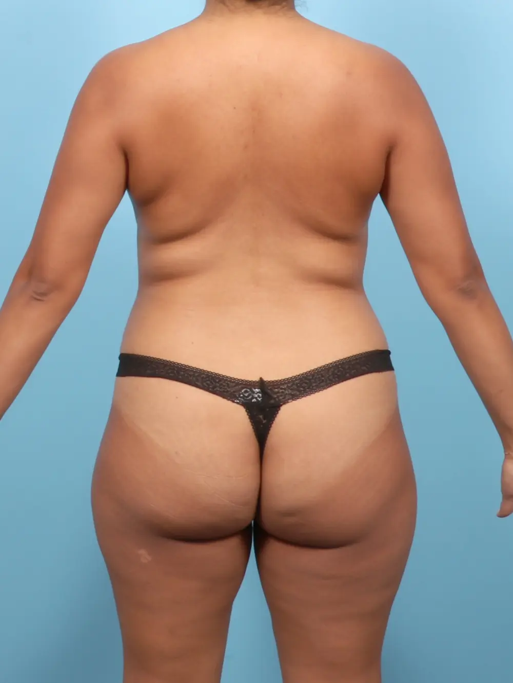 Tummy Tuck Patient Photo - Case 57464 - before view-3