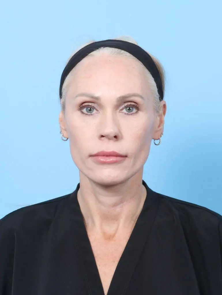 Facelift / Neck Lift - Case 57525 - After