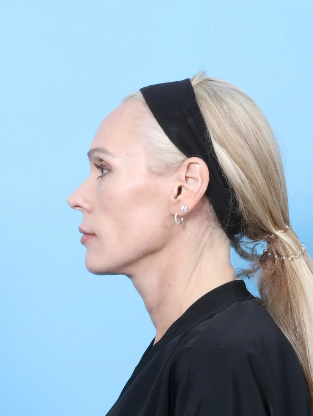 Facelift / Neck Lift Patient Photo - Case 57525 - after view-2