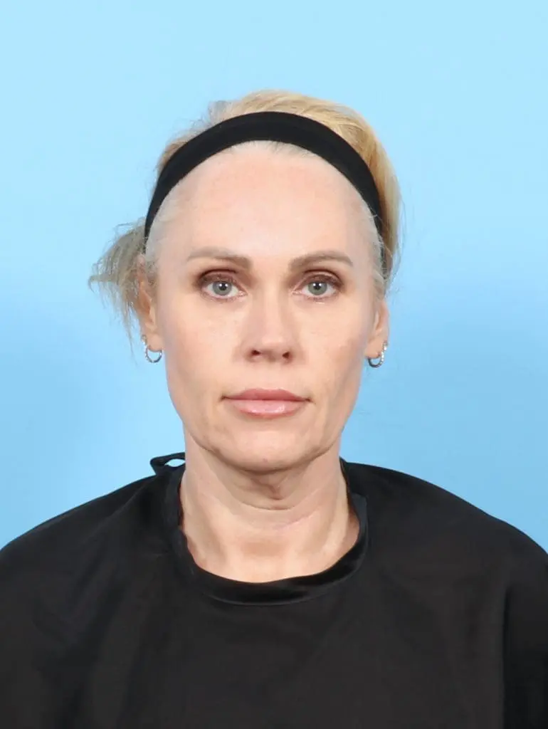 Facelift / Neck Lift - Case 57525 - Before