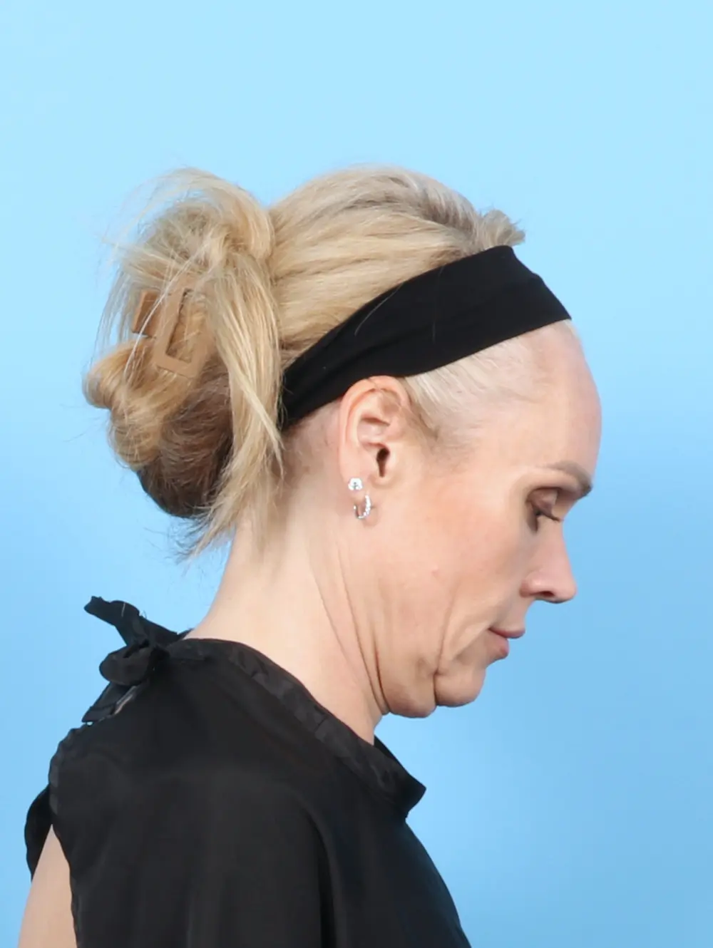 Facelift / Neck Lift Patient Photo - Case 57525 - before view-3