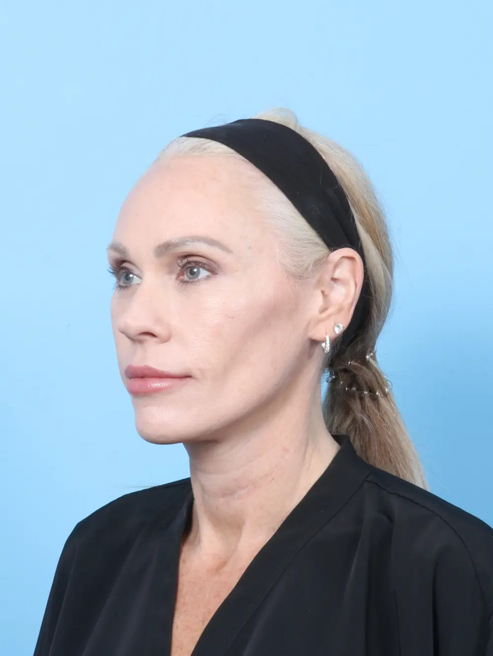 Facelift / Neck Lift Patient Photo - Case 57525 - after view-1