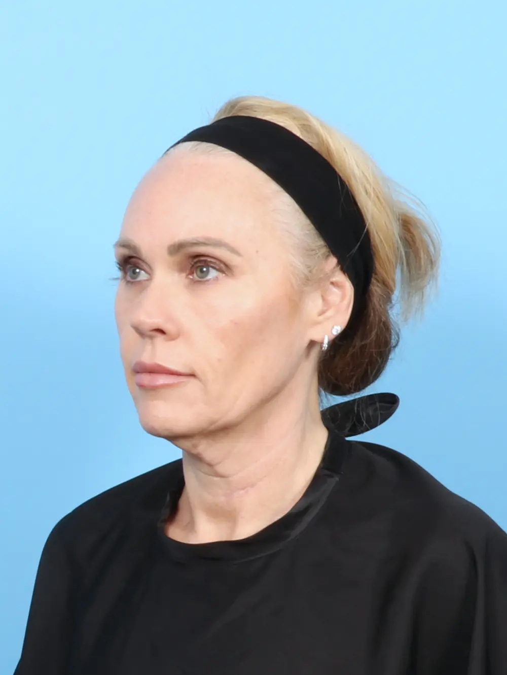 Facelift / Neck Lift Patient Photo - Case 57525 - before view-1
