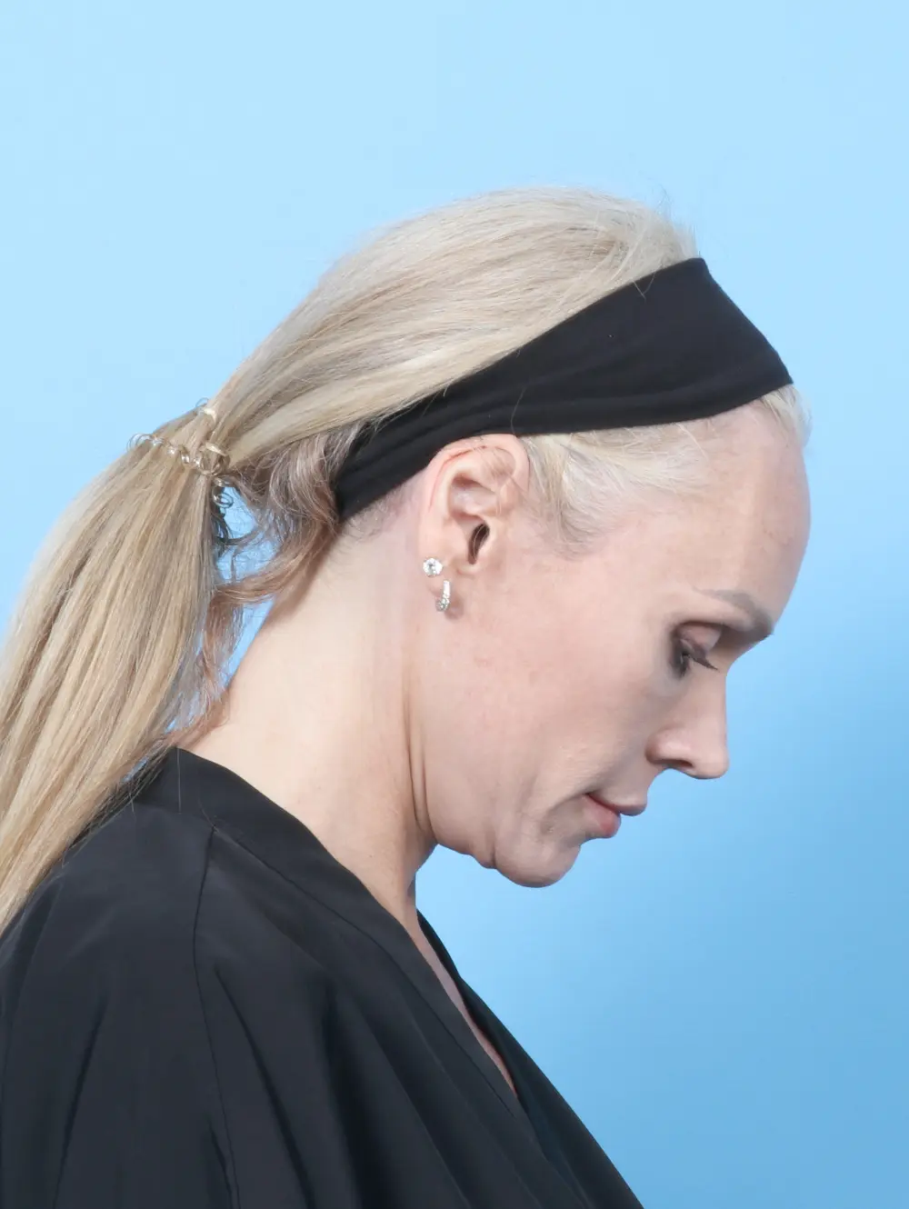 Facelift / Neck Lift Patient Photo - Case 57525 - after view-3