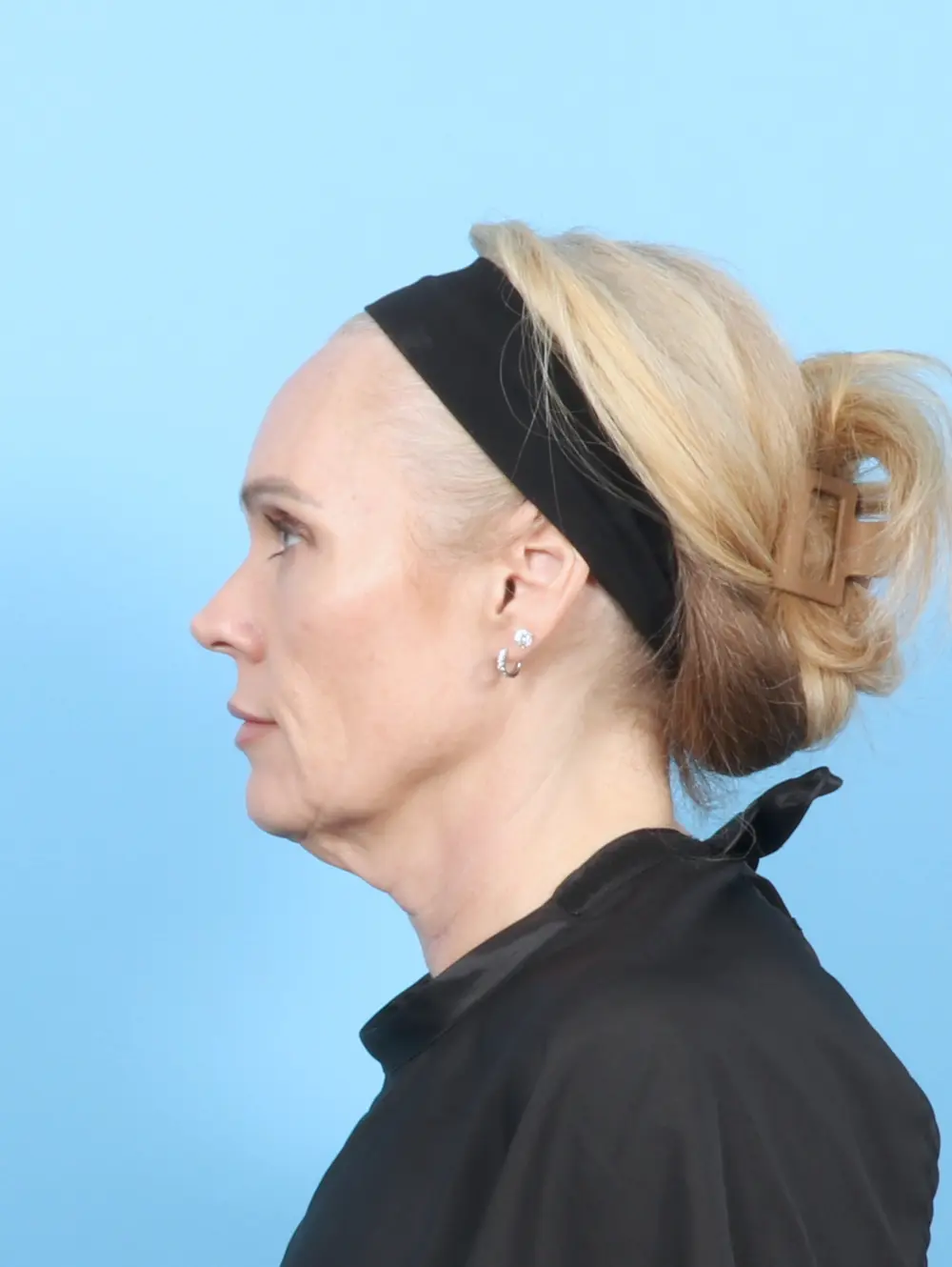 Facelift / Neck Lift Patient Photo - Case 57525 - before view-2