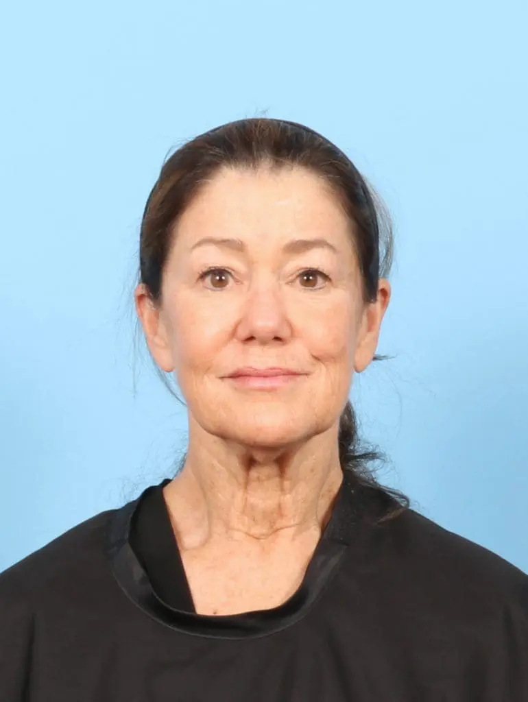 Eyelid Surgery - Case 57581 - Before